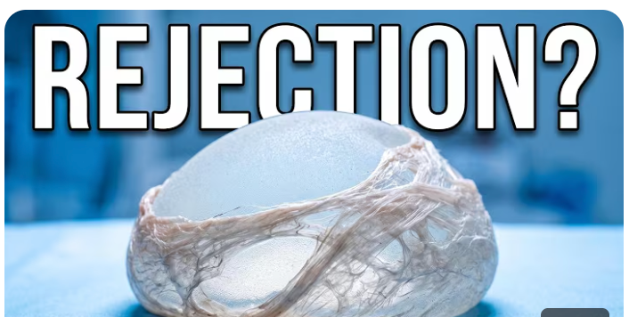Could a capsule transcriptome study change how patients hear the word rejection?